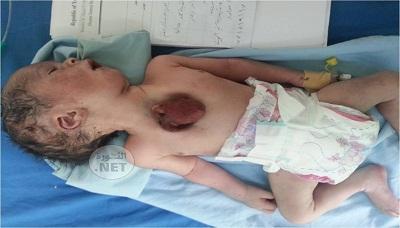 في حالة غريبة ونادرة .. ولادة طفل بقلب خارج القفص الصدري بذمار( صورة)