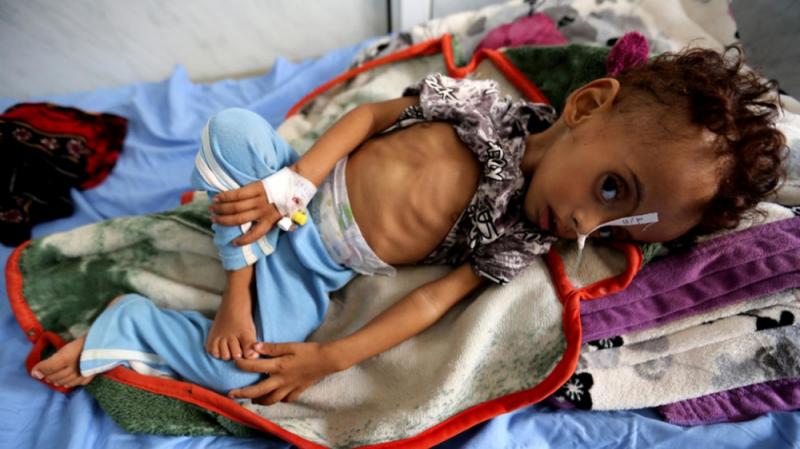 اليمن يسجل أعلى مستويات سوء التغذية بين الأطفال في العالم