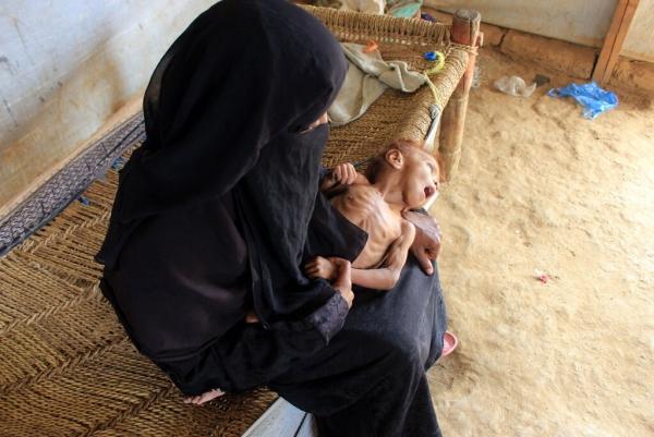 نيويورك تايمز : المجاعة تطارد اليمن مع استمرار الحرب وتراجع المساعدات الخارجية