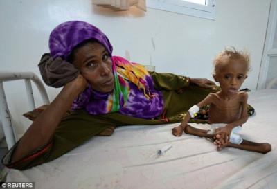 المسؤول الإقليمي لبرنامج الغذاء العالمي : الجوع في اليمن تحول إلى وباء